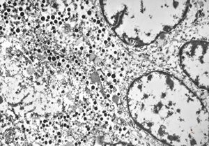 F 75 y. mixed mucinous and endocrine carcinoma - breast